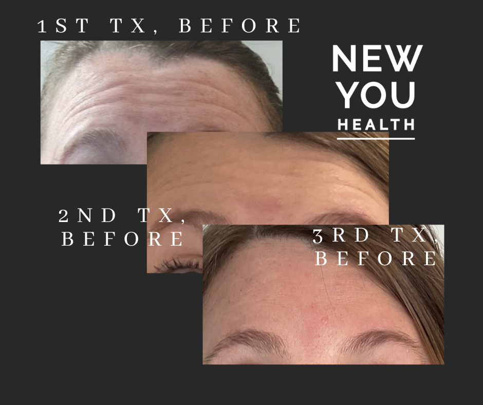 Neuromodulators, like Botox, Xeomin, & Dysport, improve your skin texture and appearance by reducing dynamic facial wrinkles with little to no downtime! With consistent treatment, wrinkles relax over time. This is demonstrated in the photo pf this client who has noticed a reduction of her forehead wrinkles over a years time. 