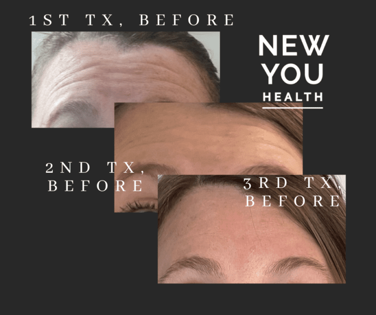 This client had never been treated with neurotoxins. The first photo (top) is prior to any treatment. The middle photo is three months later, after the Xeomin had worn off. Notice how she has less wrinkles and movement. Treated with a similar dose and 3 months later, the bottom photo demonstrated the clear improvement in the texture of her skin over time. This is a great demonstration how Botox or Xeomin can be used to prevent wrinkles!