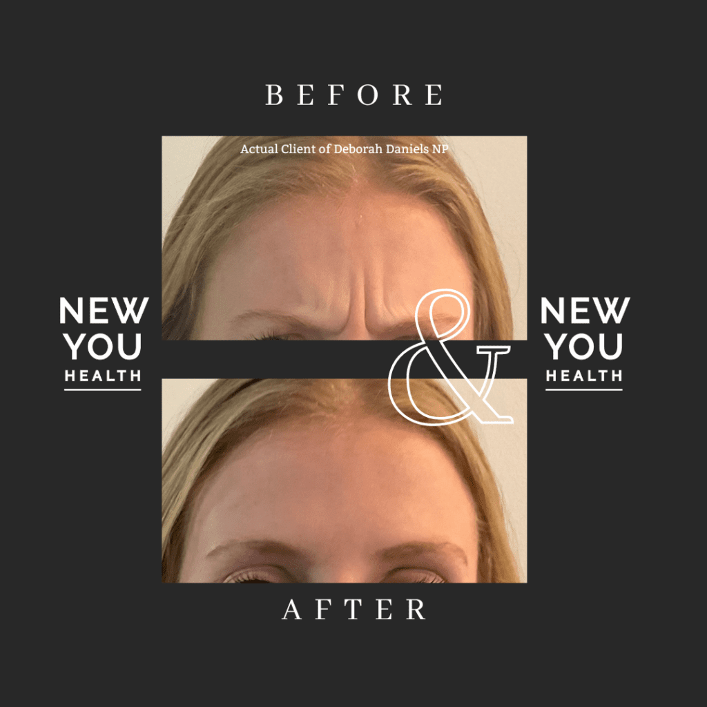 Before and after Botox or Xeomin injections. Above photo shows a young female with blonde hair animating her face in a frown. Her eyebrows are creating "11" lines. In the after photo below, the young lady makes the same expression without movement of the face. 