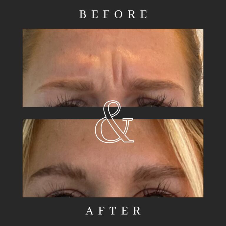 Before and After photos of a young woman's forehead being treated with botox for her forehead elevens