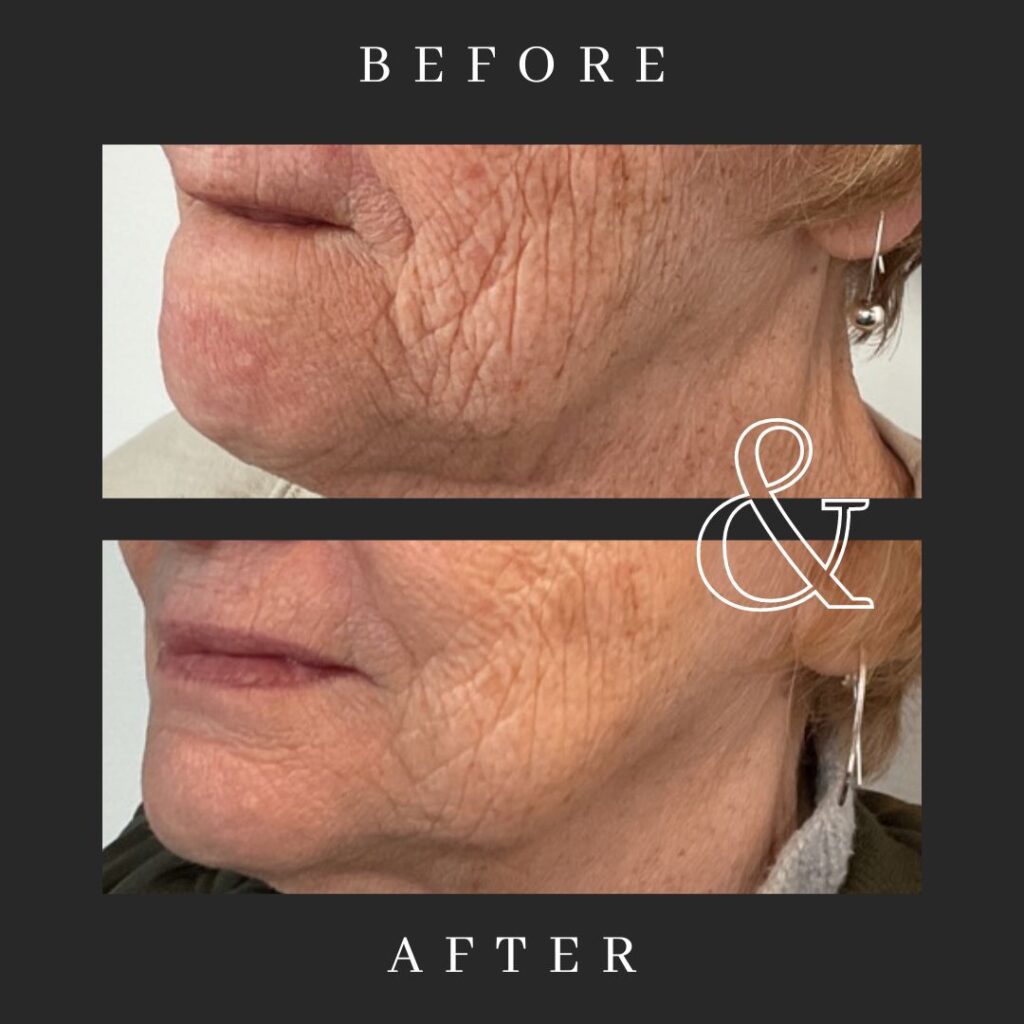 Morpheus8 Microneedling for the face and body