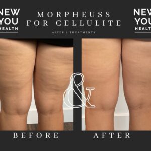 Morpheus8 Body is great for cellulite reduction