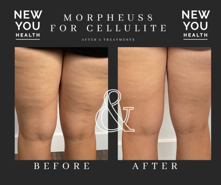 Morpheus8 Body is great for cellulite reduction