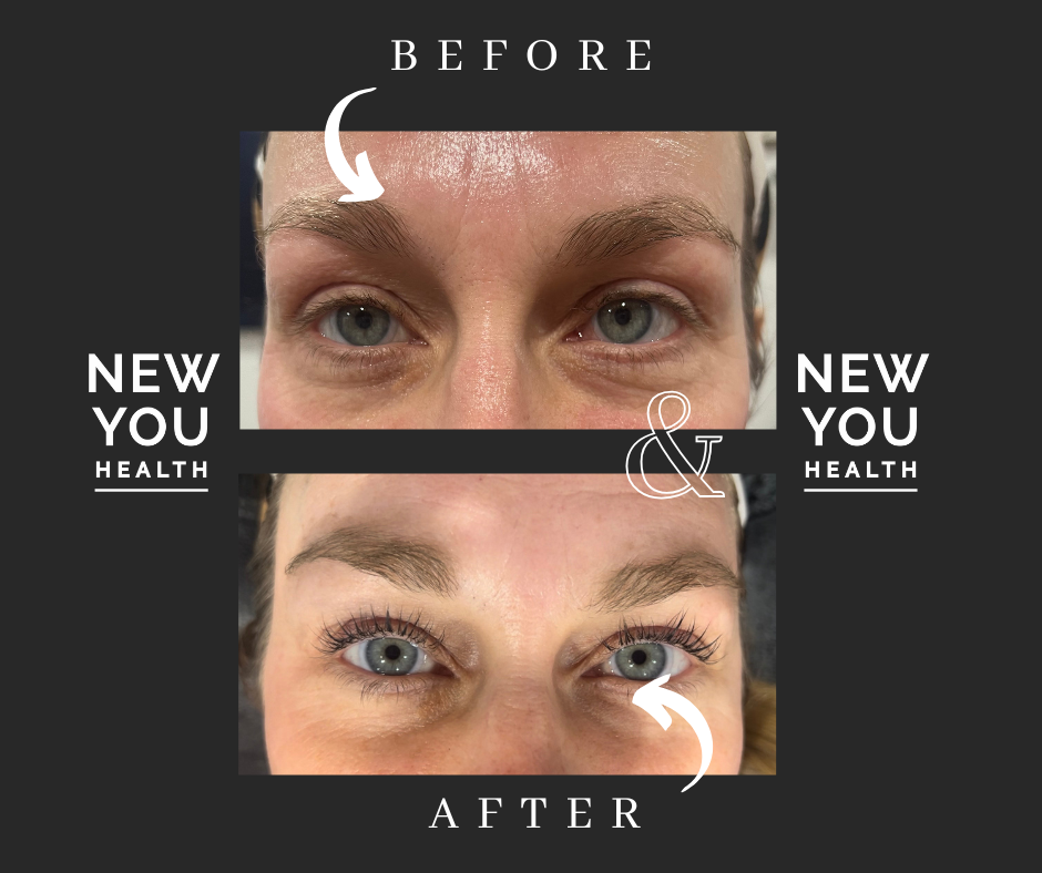Before and after photo of a Fully Confident Eyes treatment at New You Health, featuring eyebrow tint, lamination, and an eyelash lift and tint. The ‘before’ image showcases natural, unstyled brows and lashes, while the ‘after’ highlights beautifully shaped brows and voluminous, lifted lashes. This treatment enhances the eyes, creating a youthful, refreshed look by adding definition and fullness to the eyebrows and lashes, offering long-lasting results for a confident appearance.
