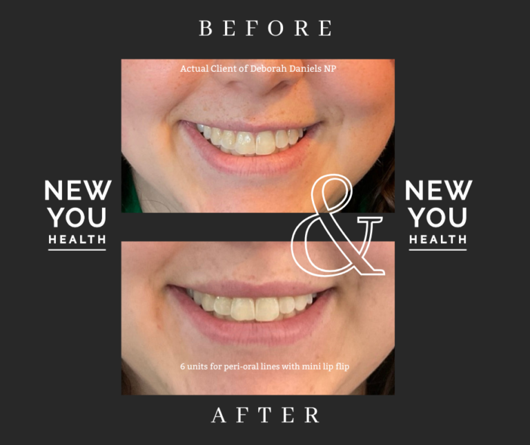 Before and after images of a mini lip flip procedure at New You Health, a med spa in Peoria, Illinois. The ‘before’ photo shows visible peri-oral lines around the mouth, while the ‘after’ photo reveals a smoother lip area and enhanced lip shape after a mini lip flip with Botox.