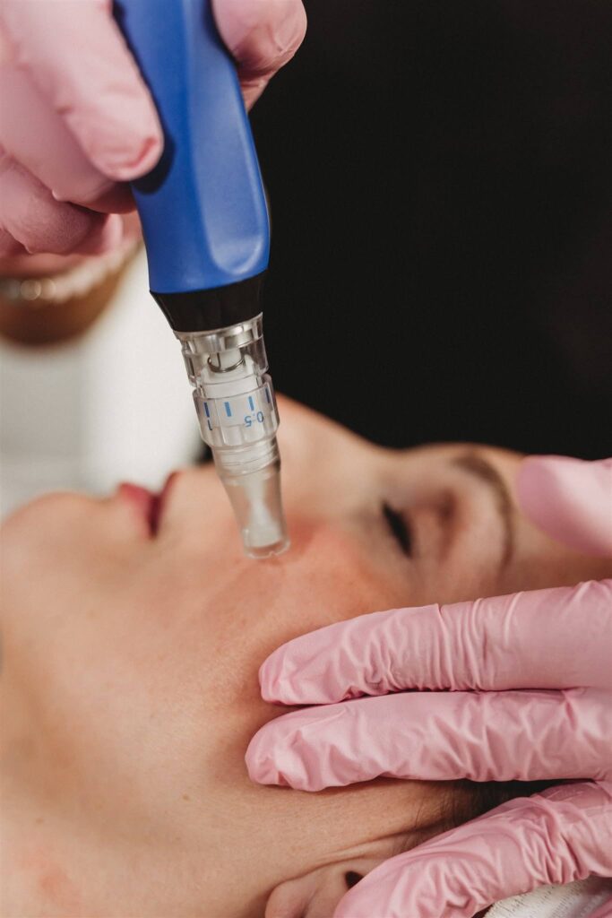 Close-up of SkinPen microneedling treatment being performed on the cheek of a client wearing pink gloves.