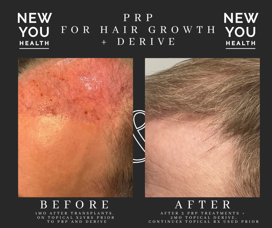 Hairline rejuvenation using PRP treatments and Derive topical therapy at New You Health in Peoria. Noticeable improvement in hair density and coverage just months after transplant. Safe, natural hair growth therapy for men and women with thinning hair.