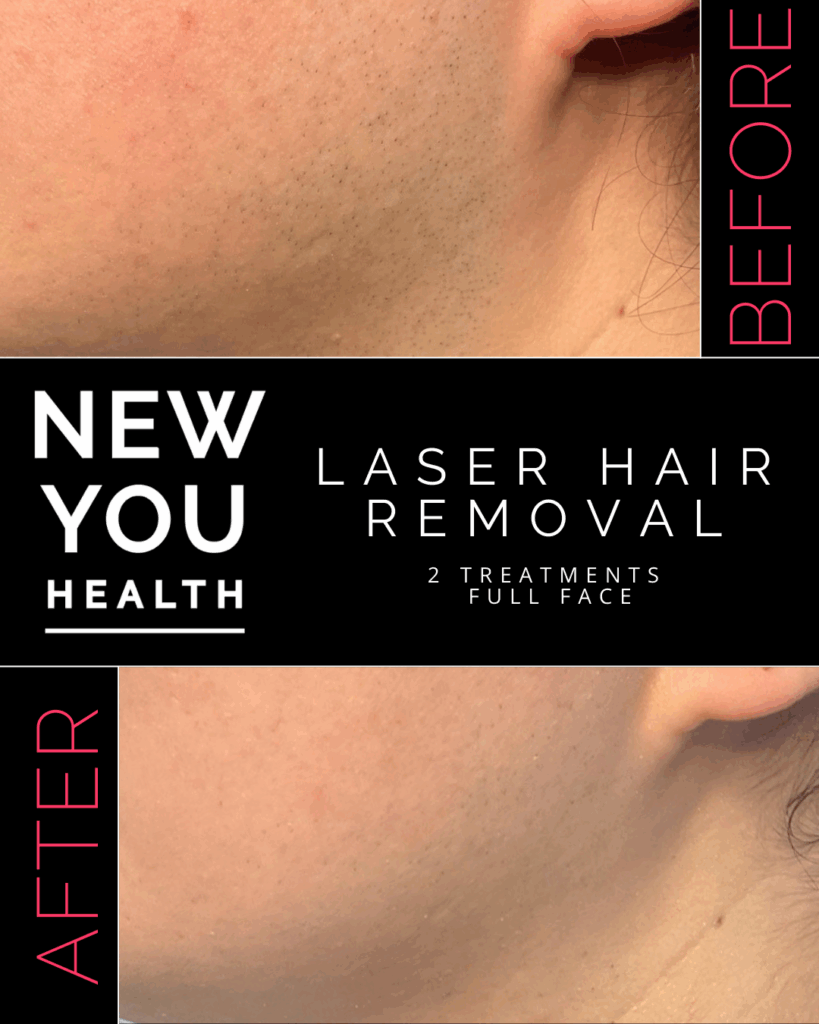 Before and after comparison of laser hair removal treatment showing significant hair reduction on treated areas, with smoother, clearer skin in the after image. This image highlights the effectiveness of professional laser hair removal services in reducing unwanted hair growth on areas such as underarms, bikini line, legs, and facial zones. Ideal for showcasing permanent hair reduction results at New You Health in Peoria, IL.