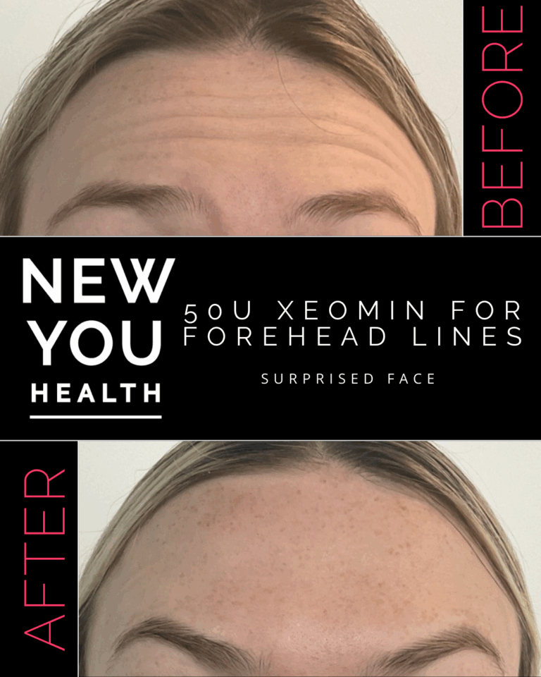 Before and after 50 units of Xeomin for forehead lines at New You Health in Peoria, IL