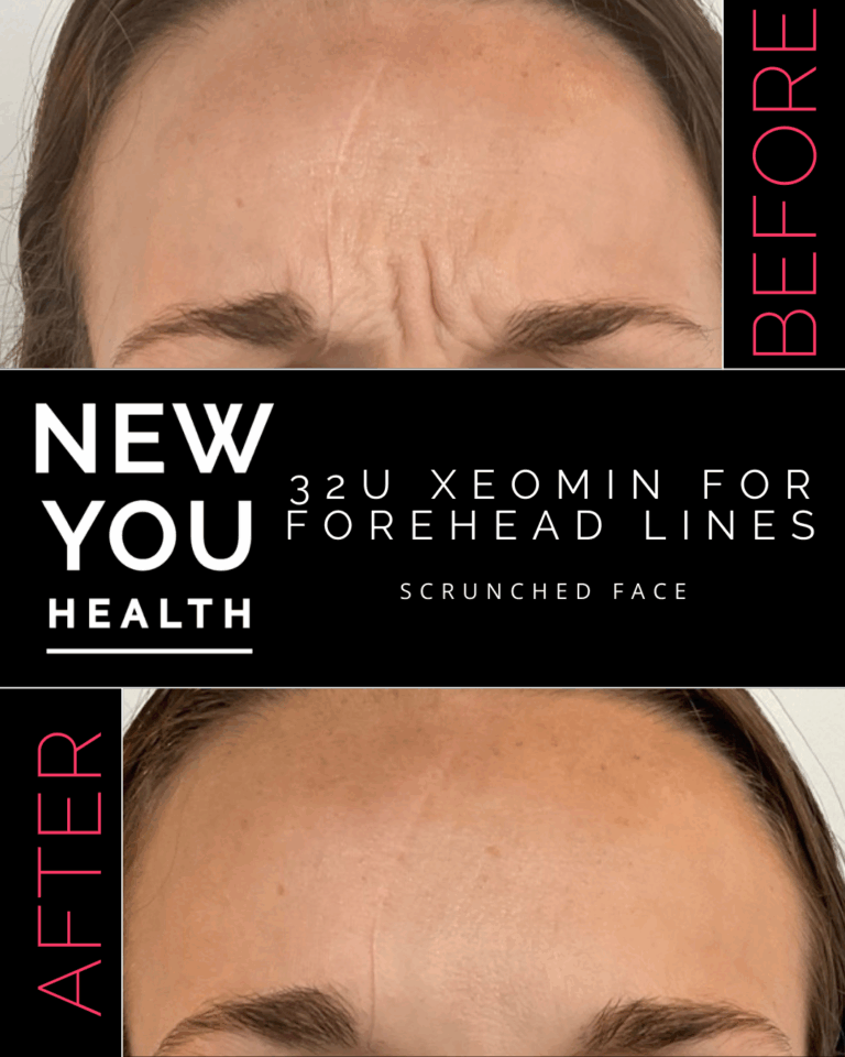 Before and after 32 units of Xeomin for forehead lines at New You Health in Peoria, IL