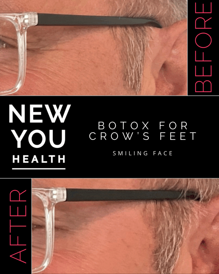 Before and after Botox for crow's feet while smiling at New You Health in Peoria, IL