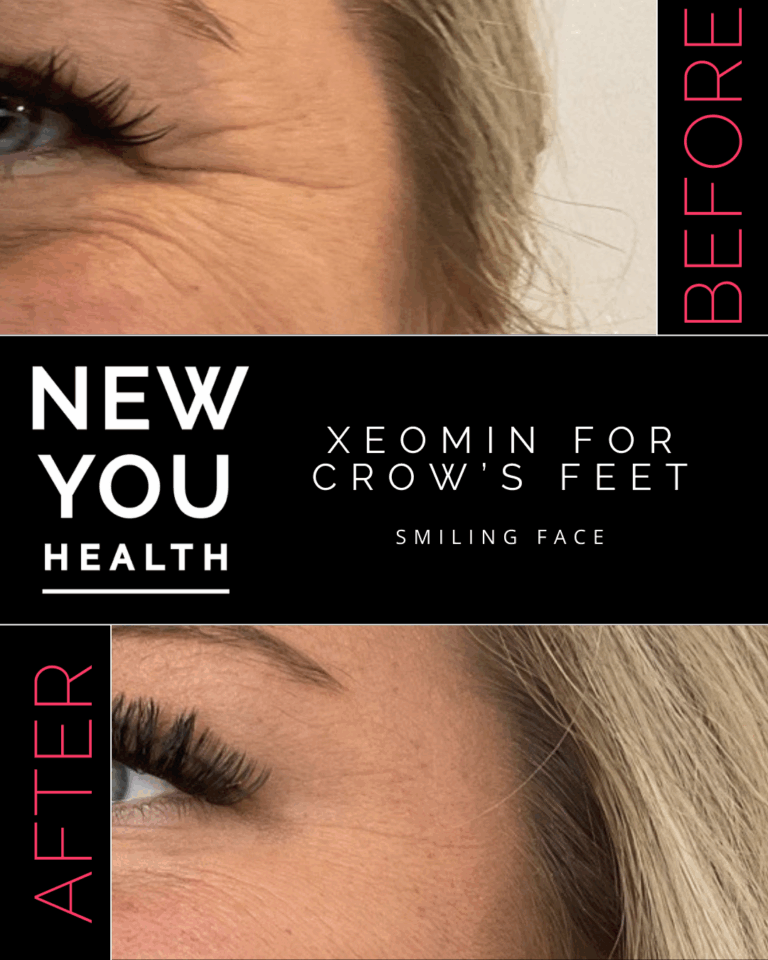 Before and after Xeomin for crow's feet while smiling at New You Health in Peoria, IL