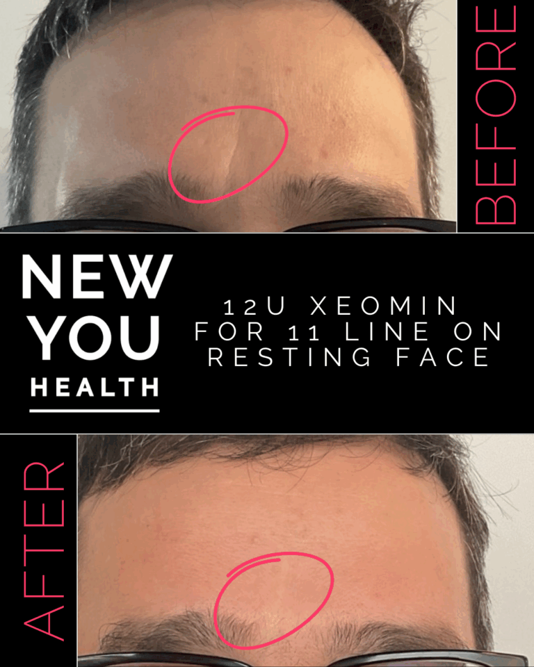 Before and after 12 units of Xeomin for 11 lines (frown lines) at rest at New You Health in Peoria, IL