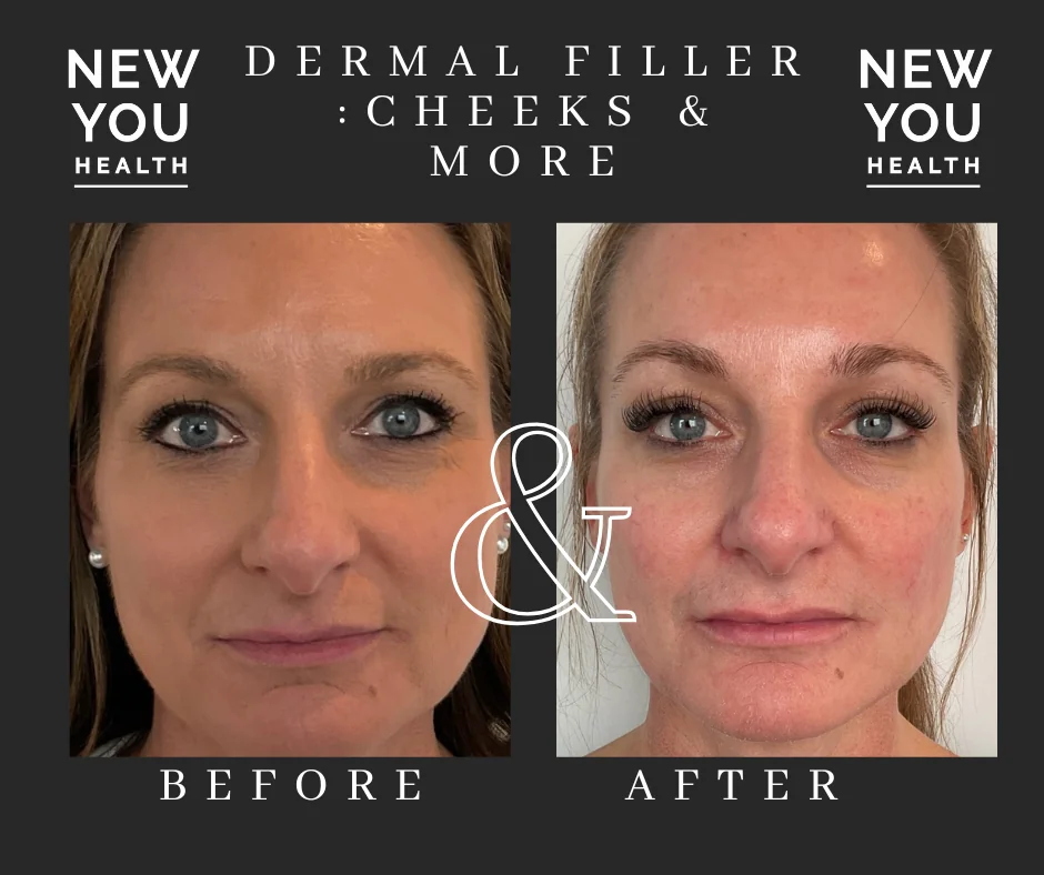 Front view before and after cheek dermal filler at New You Health in Peoria, IL
