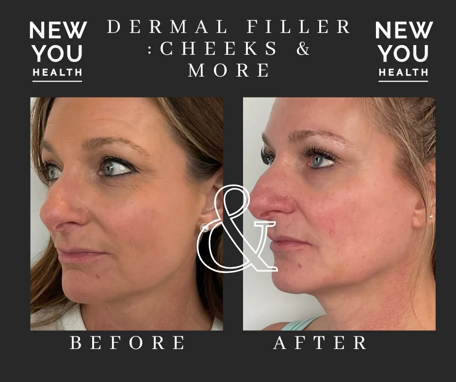 Side profile before and after cheek and jawline dermal filler at New You Health in Peoria, IL