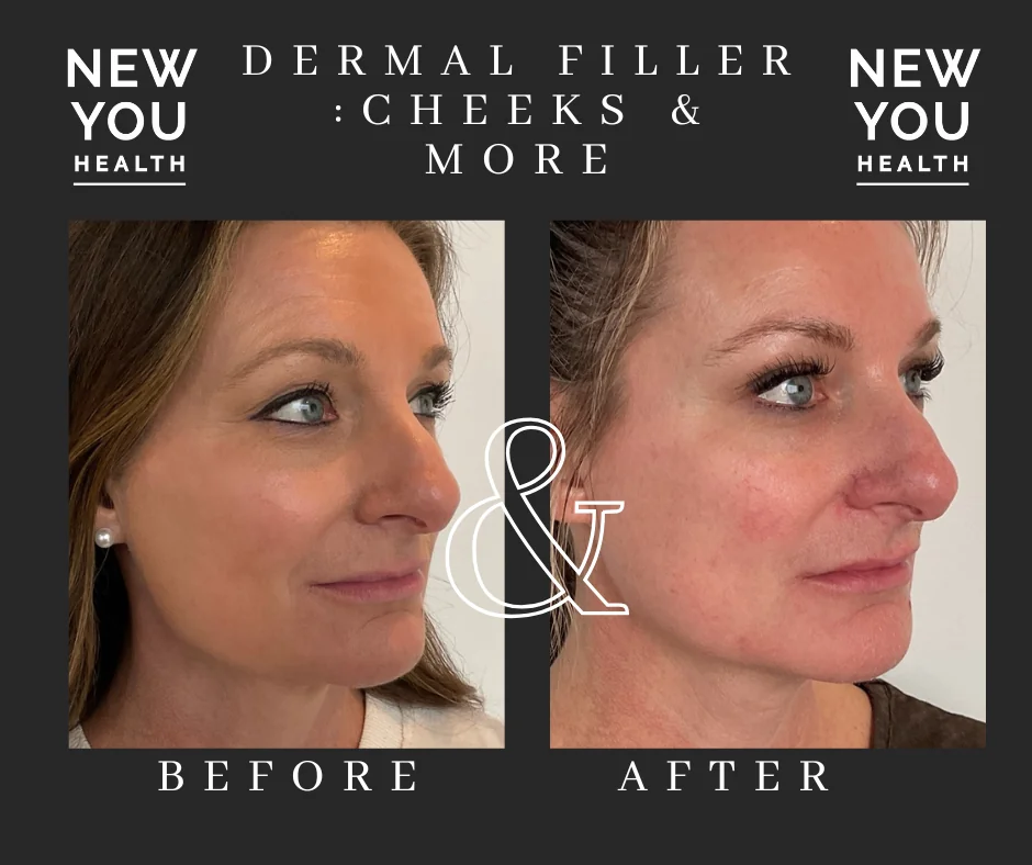 Three-quarter view before and after cheek dermal filler at New You Health in Peoria, IL