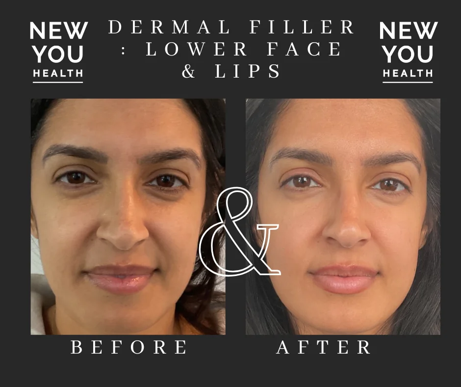 Before and after dermal filler for the lower face and lips at New You Health in Peoria, IL