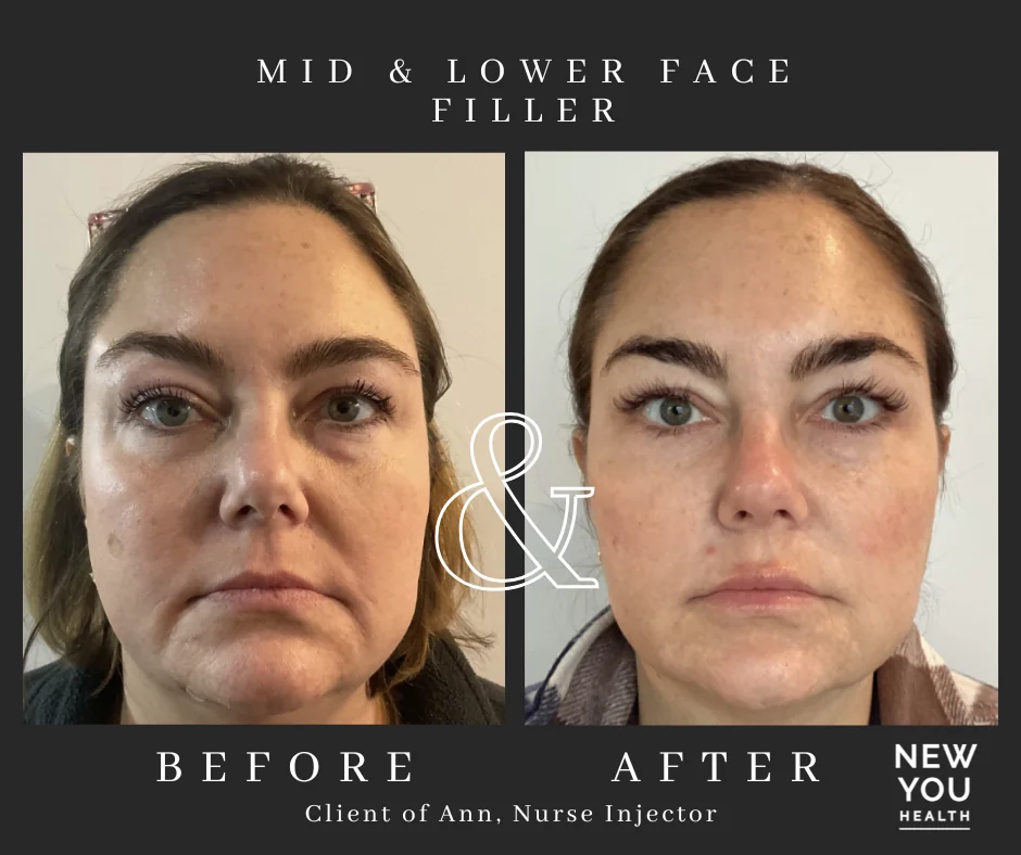 Before and after mid and lower face dermal filler by Ann Stratton, RN, at New You Health in Peoria, IL